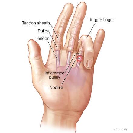 trigger finger overview mayo clinic orthopedics sports medicine