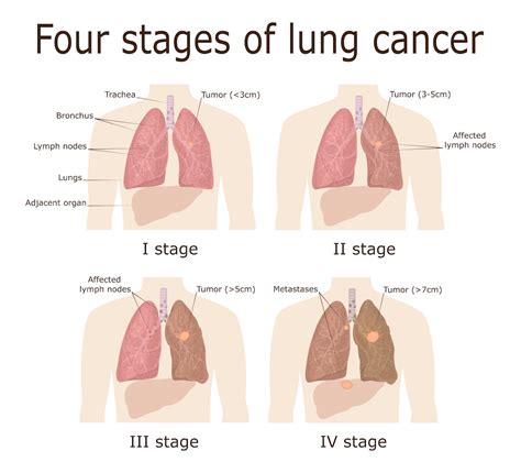 Lung Cancer Stages Symptoms And Diagnosis [video