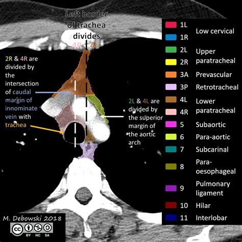 Thoracic Lymph Node Stations Annotated Ct Image Radiopaedia Org Hot
