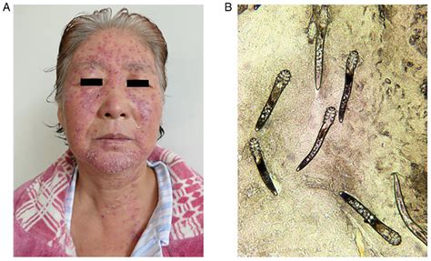clinical facial manifestations  demodex mite donors  appearance