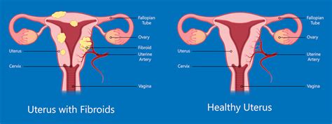 [31 ] Uterine Fibroids Signs And Symptoms