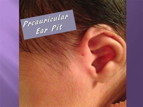 preauricular ear pit youtube