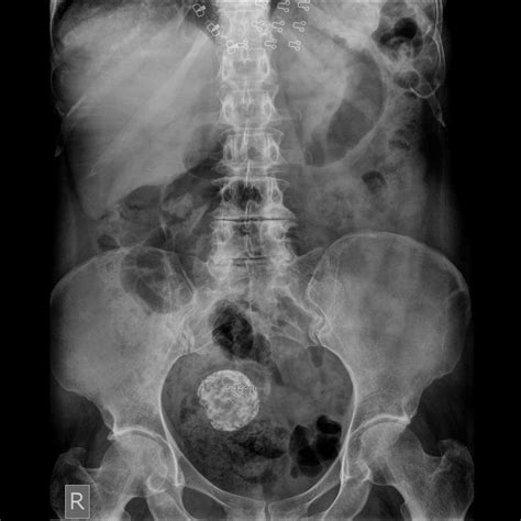 calcified uterine leiomyoma image