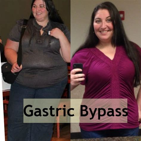Gastric Bypass Surgery 26 Quick Pros And The Cons