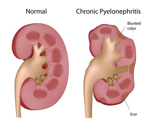 pyelonephritis net health book