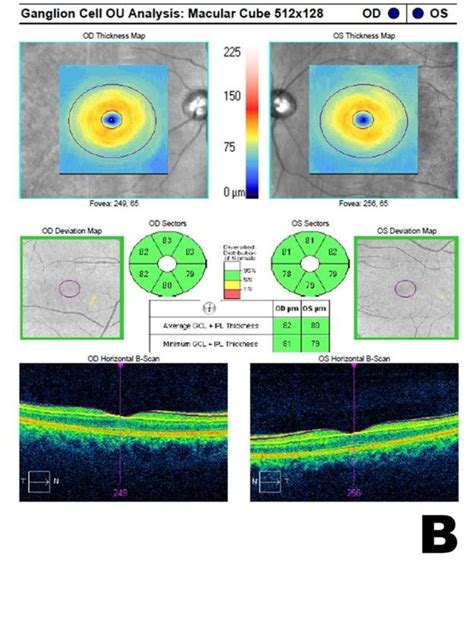 cirrus hd oct analysis   peripapillary retinal nerve fiber layer