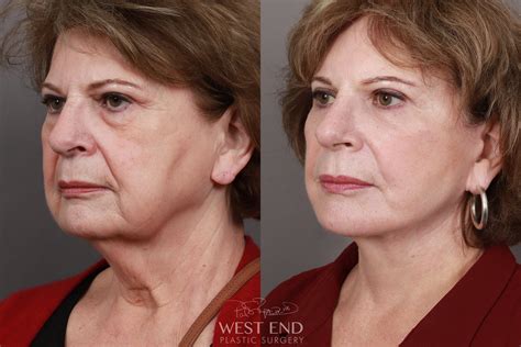 Facial Rejuvenation Before And After Gallery West End Plastic Surgery