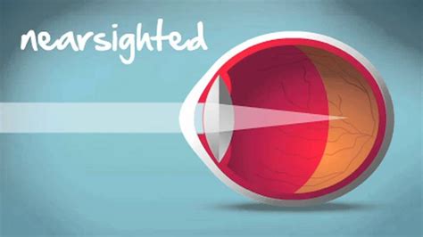 myopia hyperopia and astigmatism explained lasik eye