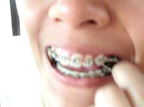 wearing rubber band  braces youtube