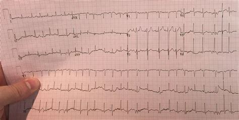 mat  afib student doctor network