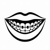 Braces Clipart Teeth Drawing Draw Clipground Paintingvalley sketch template