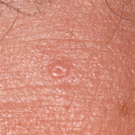 images  skin lesions  conditions  pinterest plugs straight lines  sun