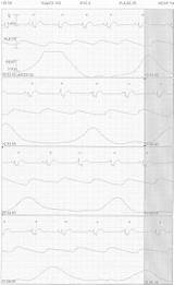 Valve Cardiology Pedi Paralysis Bioprosthetic Stridor Tricuspid Intermittent sketch template