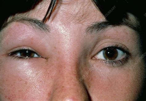 Oedema Around The Eye Due To A Bee Sting Stock Image