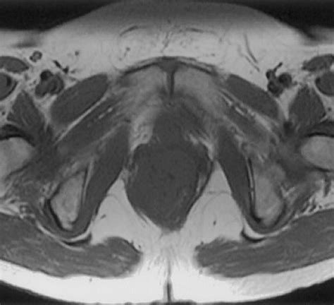 Mr Imaging Of Common And Uncommon Large Pelvic Masses Radiographics