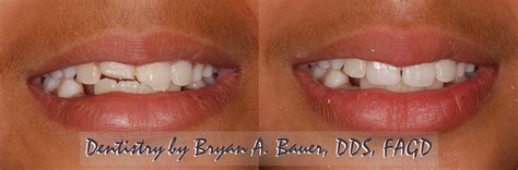 broken front teeth fixed  dr bauer bauer smiles