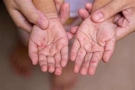 hand foot  mouth disease hfmd signs  symptoms