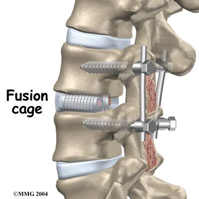 lumbar fusion  cage  pedicle screws spine surgery spinal fusion surgery spinal fusion