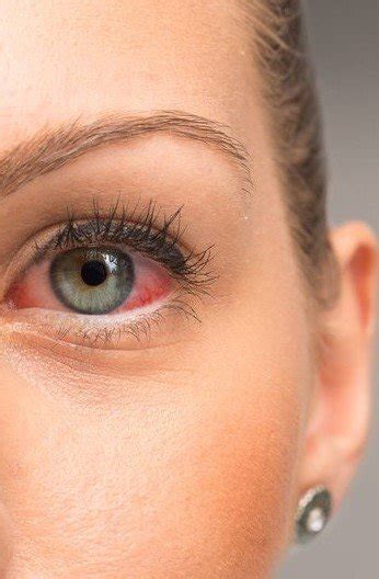 dry eyes expert — the eyeclinic by dr cheryl lee