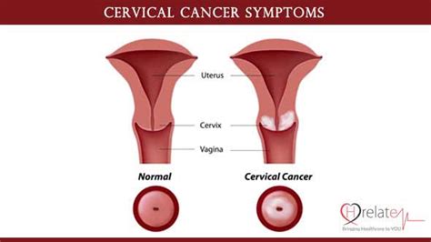 cervical cancer symptoms in hindi mahilao mai iske karan hrelate