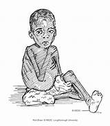 Kwashiorkor Child Wedc Marasmus Graphics Polio Sick Artist Chil Shaw Rod Lboro Ac Resources sketch template