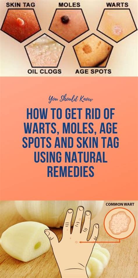 how to get rid of warts moles age spots and skin tag using natural