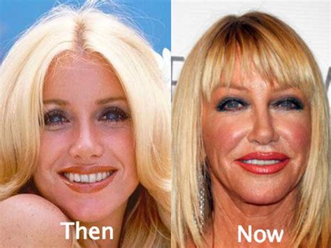 24 Worst Celebrity Plastic Surgery Before And After