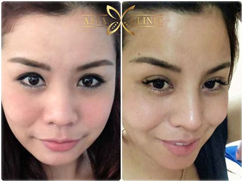 rhinoplasty before after