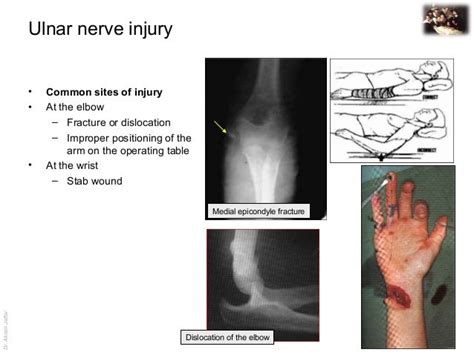 applied anatomy ulnar nerve injury
