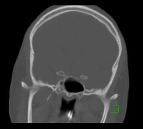 bilateral temporomandibular joint dislocation image