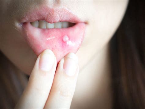 here s what you can eat to cure mouth ulcers times of india