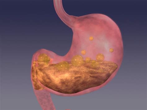 antral gastritis types  symptoms  treatment