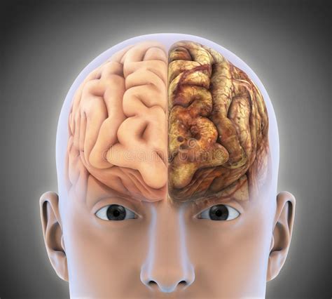 de gezonde hersenen en de ongezonde hersenen stock illustratie illustration  anatomisch