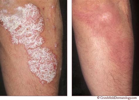 psoriasis treatment stop itching crutchfield dermatology