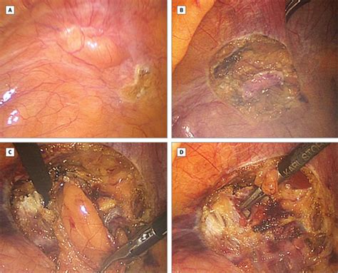 outcomes of laparoscopic vs open repair of primary ventral hernias