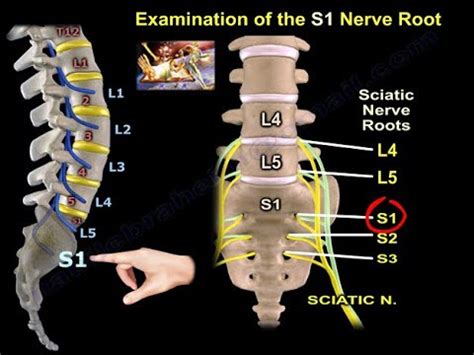 nerve root nerve roots pain relief     comfortable allowing  disc