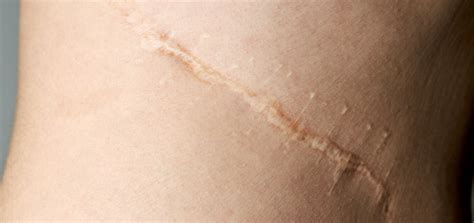 scars dermatology  skin health dr mendese