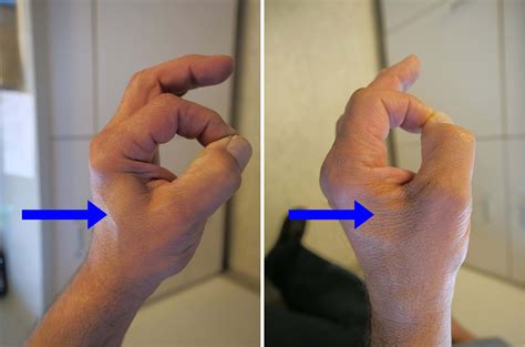 Ulnar Nerve Entrapment At The Elbow Cubital Tunnel