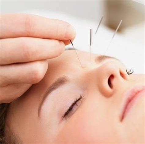 acupuntura estética