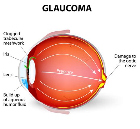 prosthetic eye  glaucoma ocular prosthetics