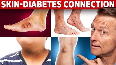 diabetic skin problems   diabetes youtube