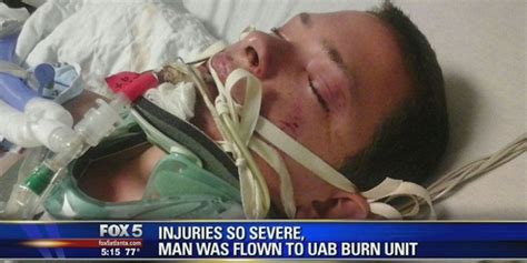23 Year Old Severely Injured When E Cigarette Exploded In His Mouth