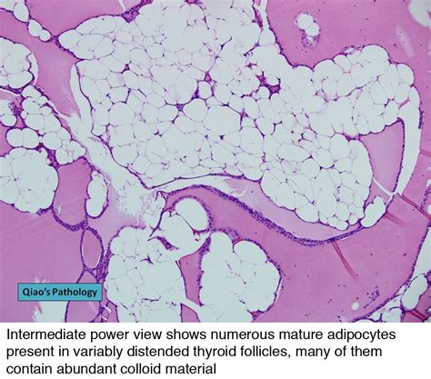 pathology outlines adenolipoma