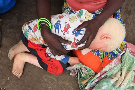 malawi finally bans witchdoctors from using albinos