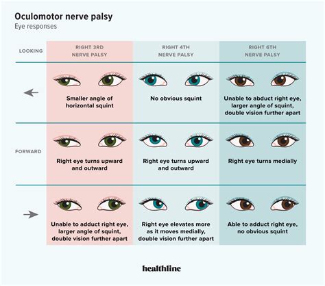 guide  oculomotor nerve palsy   treatment