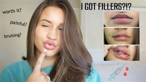 I Got Lip Fillers Everything You Need To Know Before And Afters Youtube