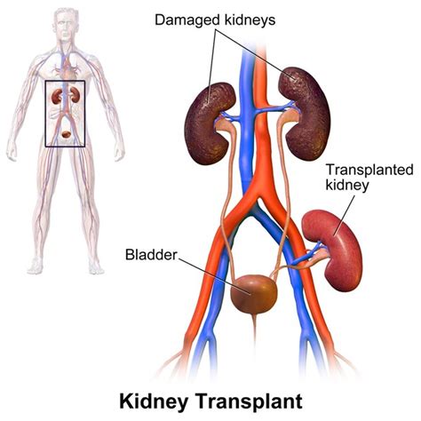 kidney transplant types procedure risk cost   relief