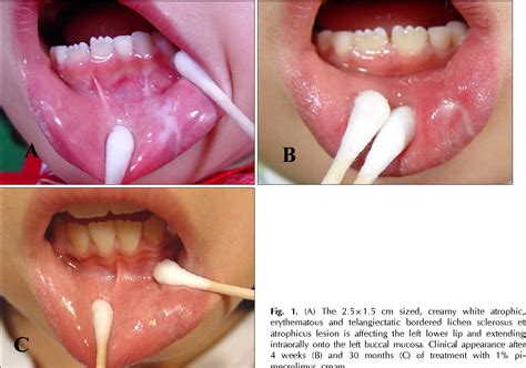 figure 1 from treatment of oral lichen sclerosus with 1