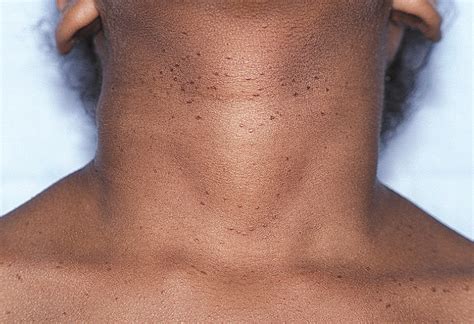 neck and vulvar papules in an 8 year old girl jama dermatology jama