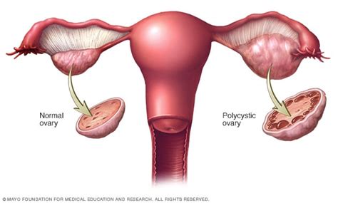 polycystic ovary syndrome mayo clinic
